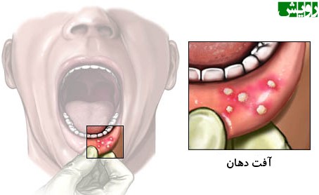 آفت دهان - mahu.ir