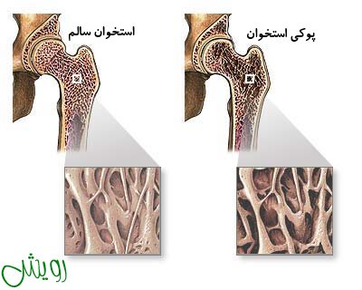 پوکی استخوان - mahu.ir