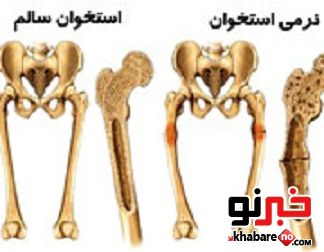 اشنا شدن با نرمی استخوان یا استئومالاسی 1