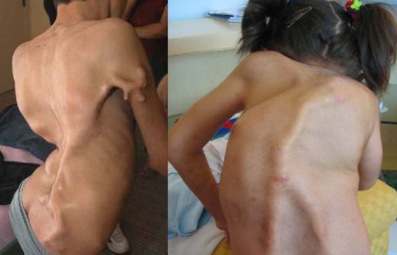 http://s3.picofile.com/file/8192976726/Fibrodysplasia_Ossificans_Progressiva_Pictures_2.jpg