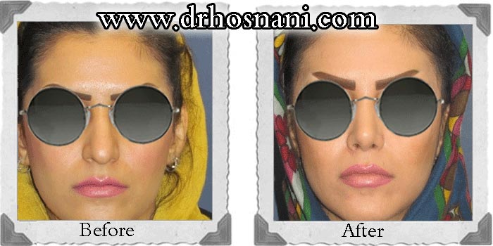 دکتر حسنانی جراح بینی