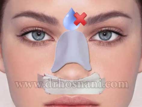 اسپلینت خیس